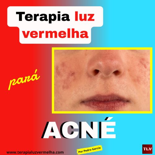 solução não invasiva para o acne com terapia de luz vermelha